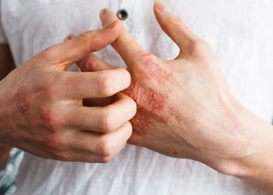 Eczema